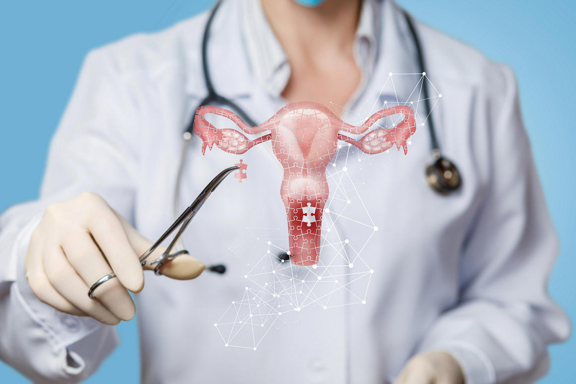 Стадии аденомиоза матки Аденомиоз матки