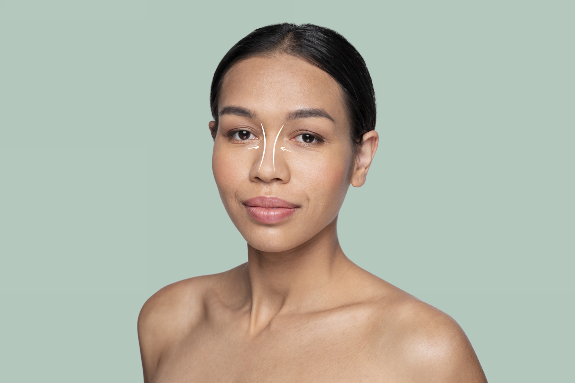 Ринопластика при широких ноздрях