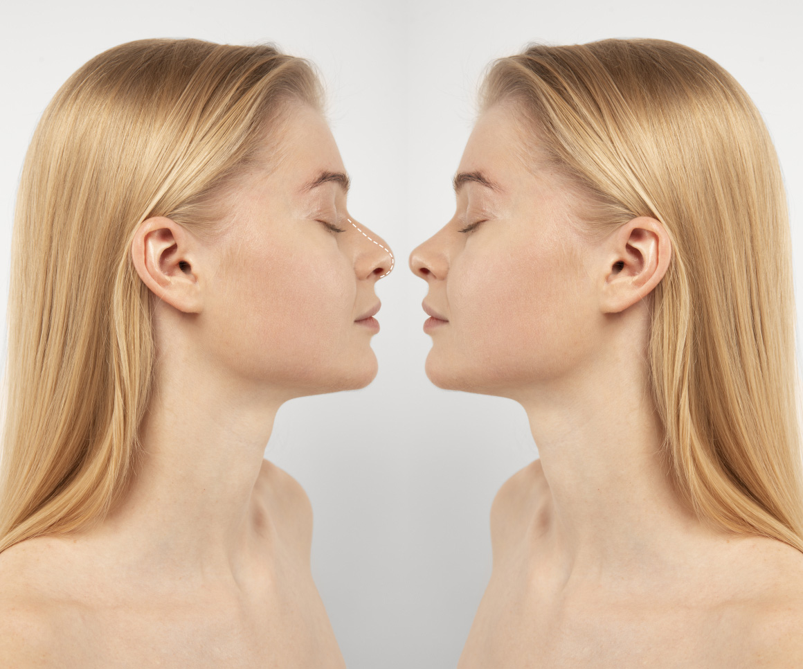 Ринопластика - фото до и после. Оперировал Усачёв И.А.