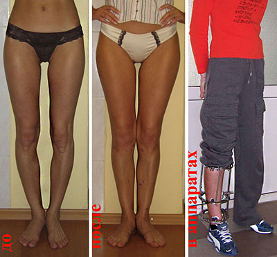 Коррекция кривизны и длины ног. Оперировал д.м.н.А.А.Артемьев.