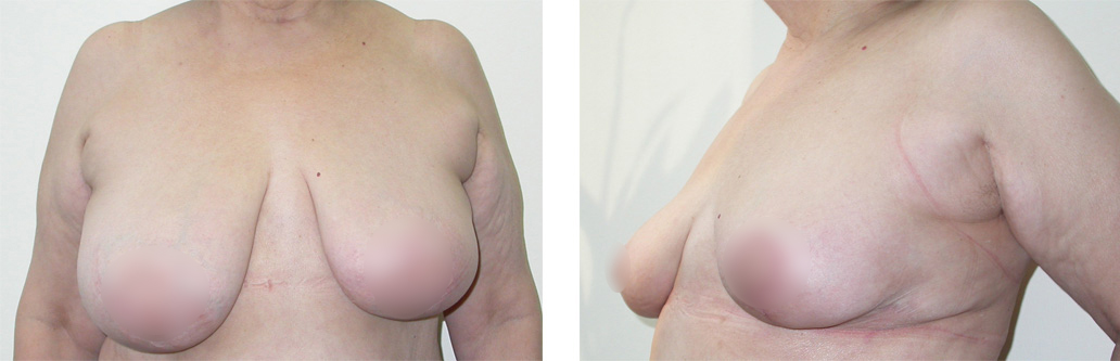 Уменьшение груди и коррекция асимметрии