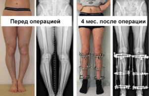 Коррекция формы и длины ног. Операцию выполнил Артемьев А.А.