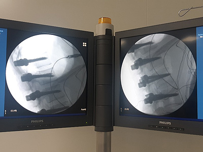 Хирургическая коррекция сколиоза пациентке 37 лет. Оперировал – ортопед, нейрохирург, д.м.н. Бакланов А.Н.