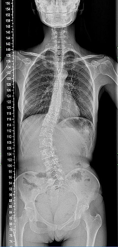 1. Идиопатический грудопоясничный С образный правосторонний сколиоз Th12-L4 43 градуса.
