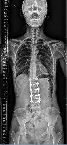 2. Состояние после операции по хирургической коррекции сколиоза пациентке 37 лет д.м.н. Баклановым А.Н.